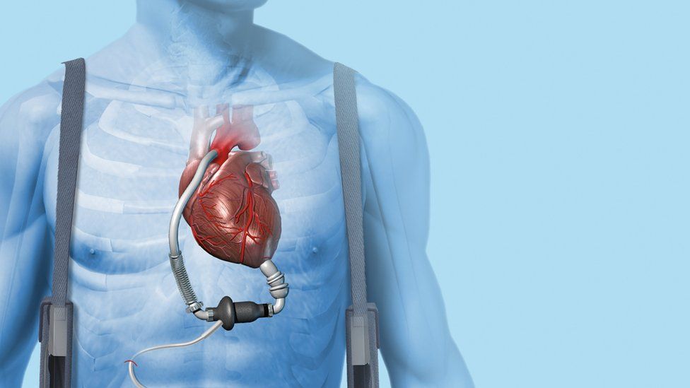 Global Cardiac Assist Devices Market is Estimated to Witness High Growth Owing to Rising Incidence of Cardiovascular Diseases