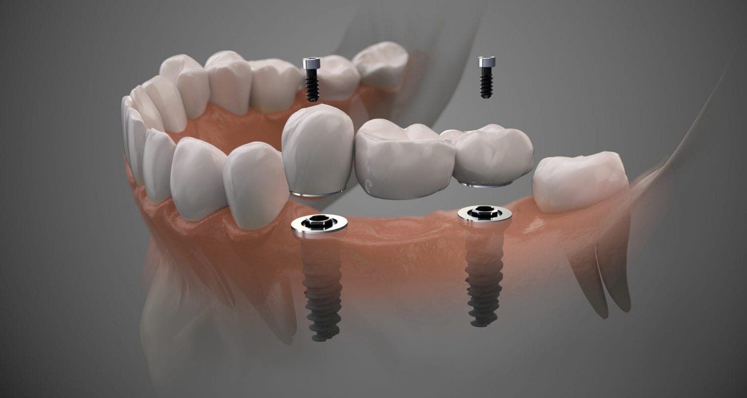 Global Dental Implants Market Is Estimated To Witness High Growth Owing To Increasing Dental Implant Surgeries