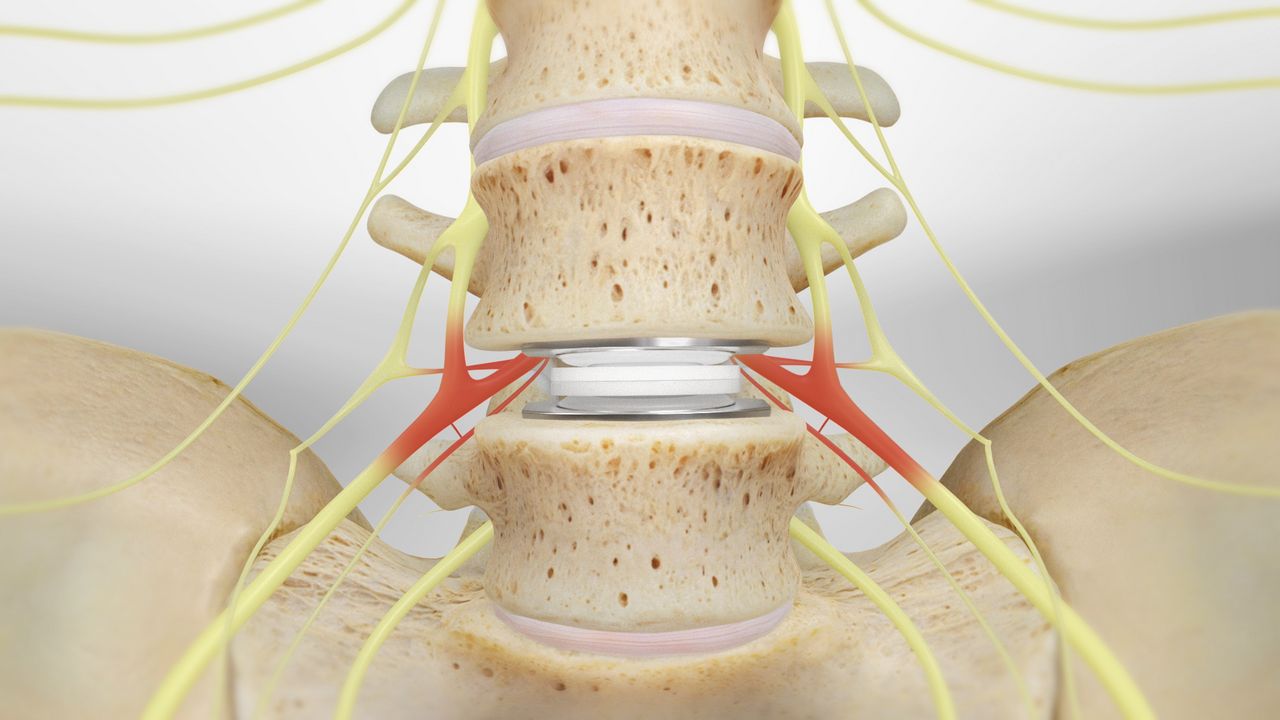 Artificial Discs Market: The Future of Spinal Care market