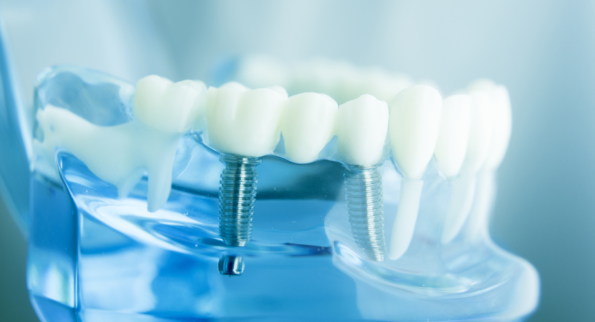 Global Dental Implants Market Is Estimated To Witness High Growth Owing To Rising Dental Tourism & Increasing Number of Tooth Replacement Procedures