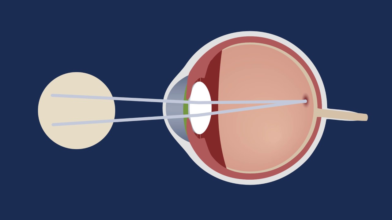 Myopia And Prebyopia Eye Drops