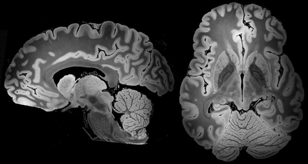 New Design Achieves 10-Fold Better Resolution for Functional MRI Brain Imaging