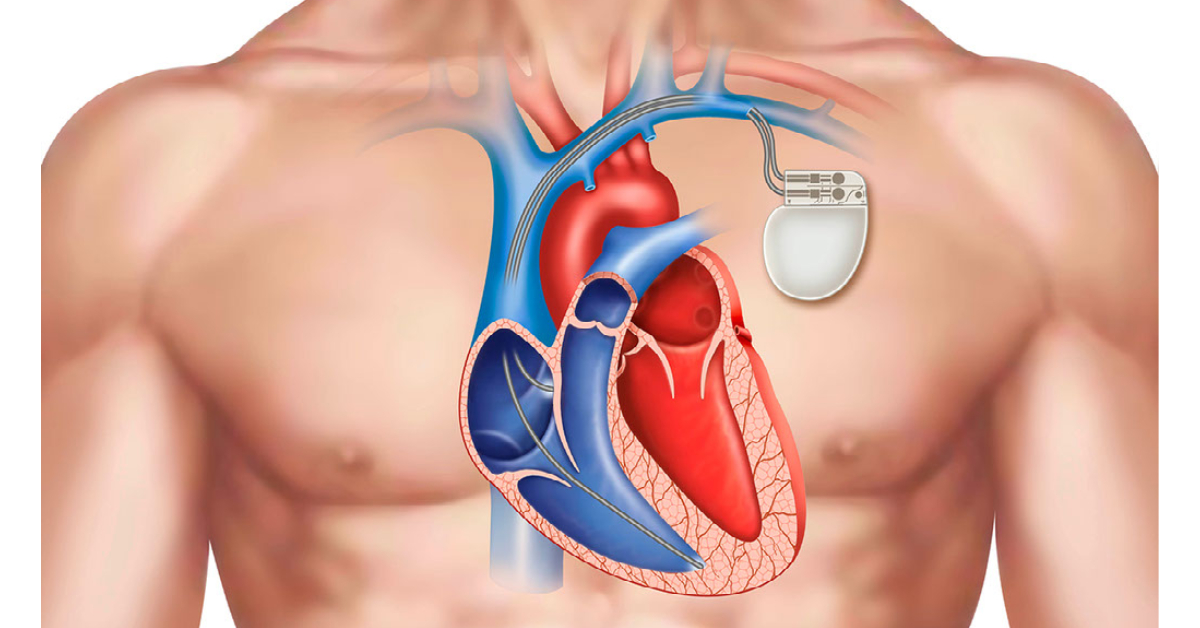 The Global Brazil Cardiac Pacemakers Market Is Estimated To Propelled By Technological Advancements