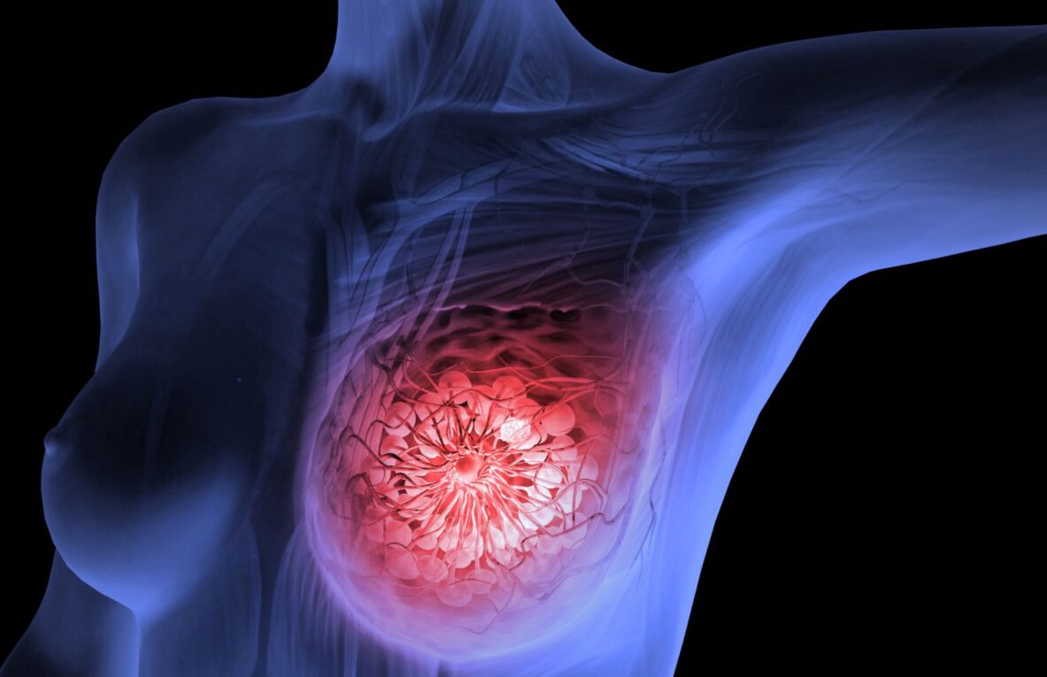 Promising New Drug Candidate Discovered for ER-Positive Breast Cancer