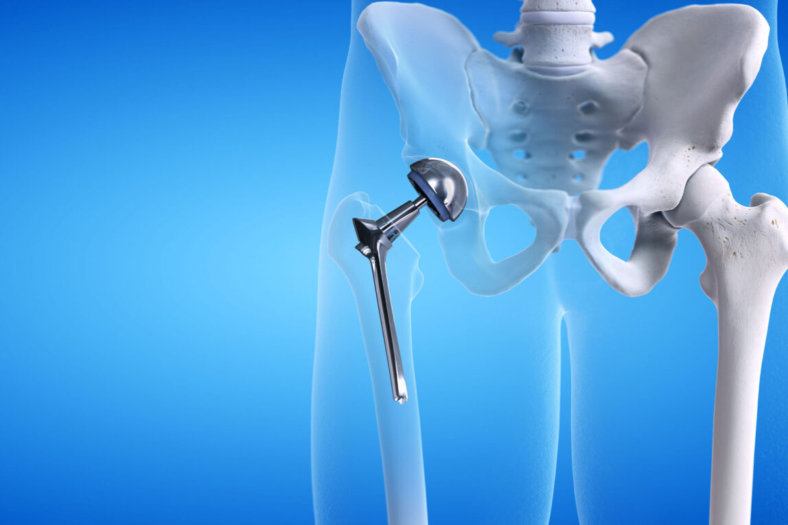 Medical Device Segment Is The Largest Segment Driving The Growth Of The Hip Replacement Market
