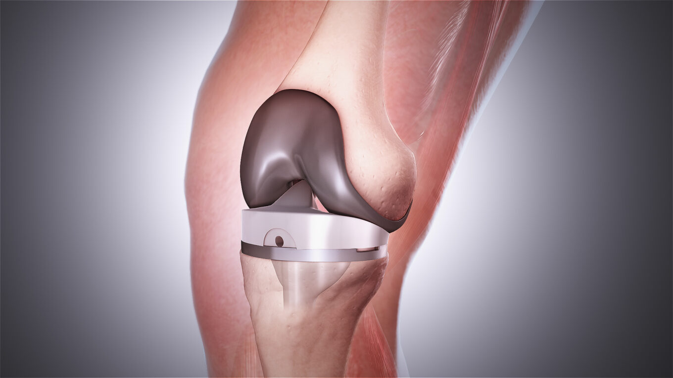 Total Knee Replacement Segment is the largest segment driving the growth of Knee Replacement Market