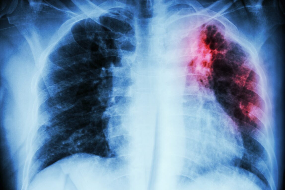 New Antibiotic Molecules Discovered for Treating Drug-Resistant Tuberculosis