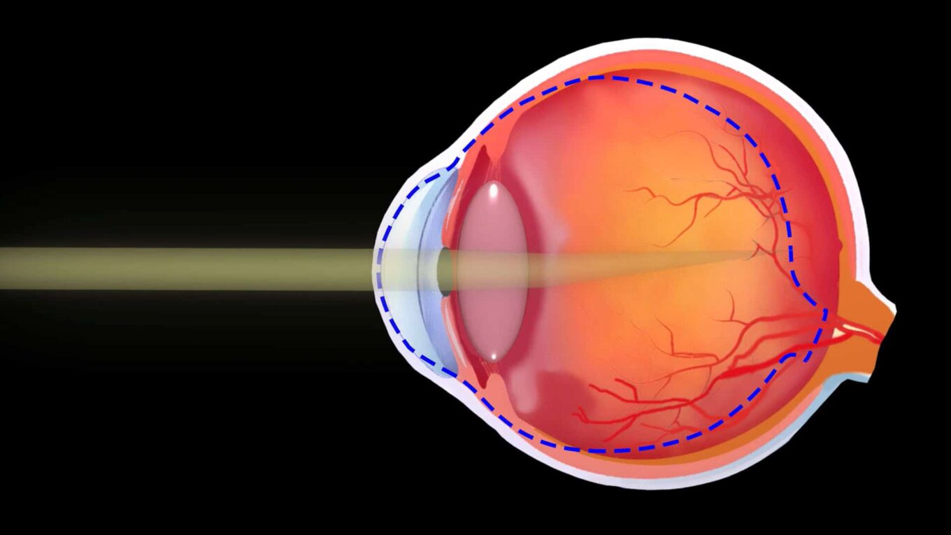 Myopia And Presbyopia Treatment Market Propelled By Increasing Prevalence Of Myopia And Presbyopia