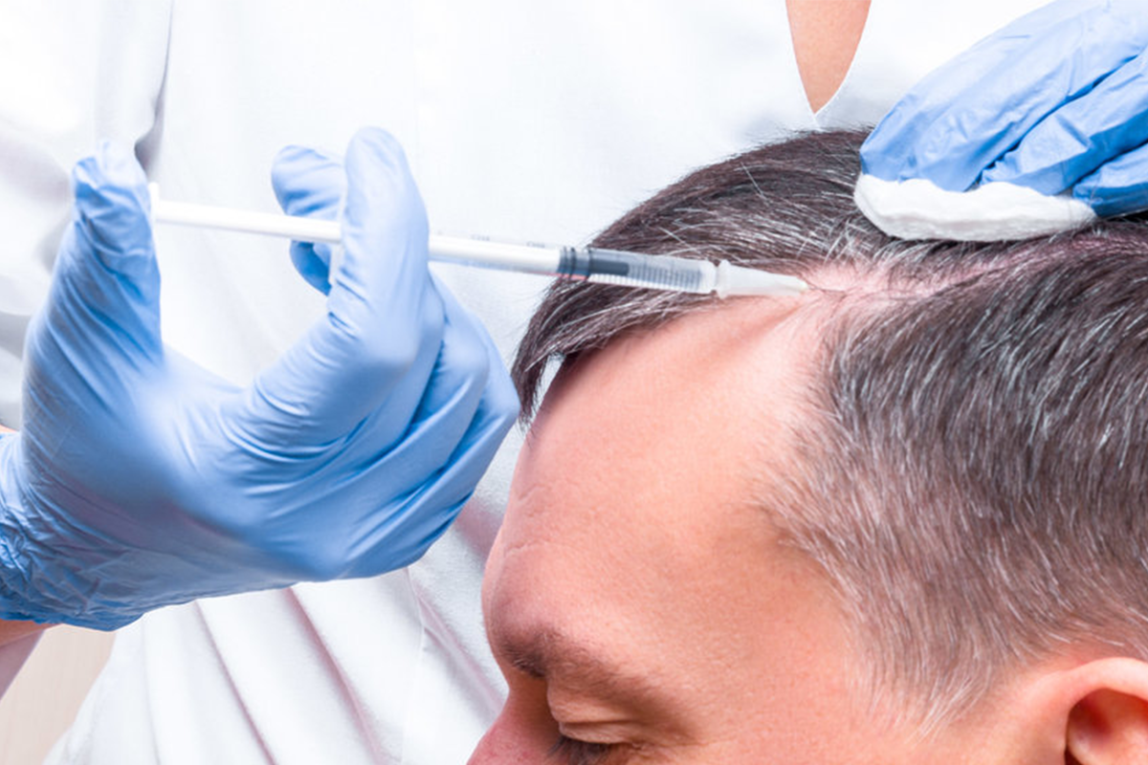 The Global Scalp Care Market Is Estimated To Propelled By Rising Awareness On Maintaining Hair And Scalp Health