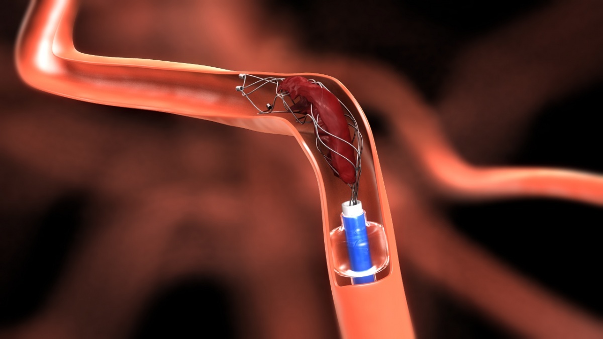 Neurovascular Devices Market Is Estimated To Witness High Growth Owing To Advancement In Non-Invasive Procedures