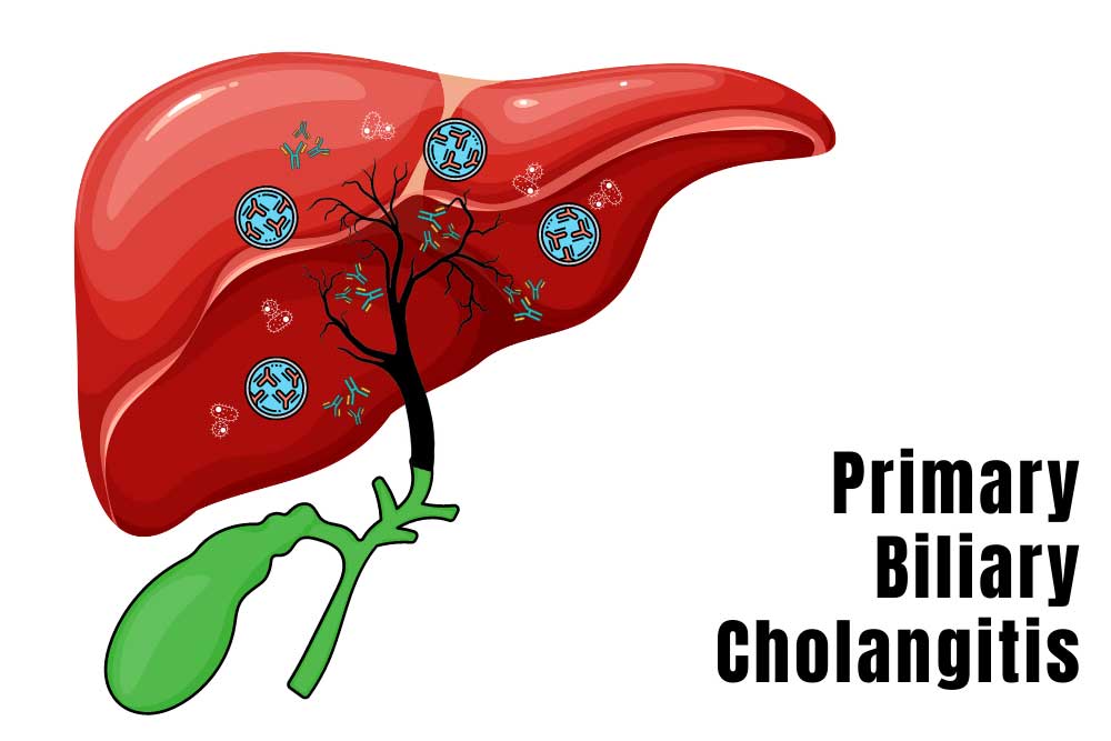 Primary Sclerosing Cholangitis Market Estimated To Witness High Growth Owing To Increasing Awareness Regarding Disease Diagnosis And Treatment