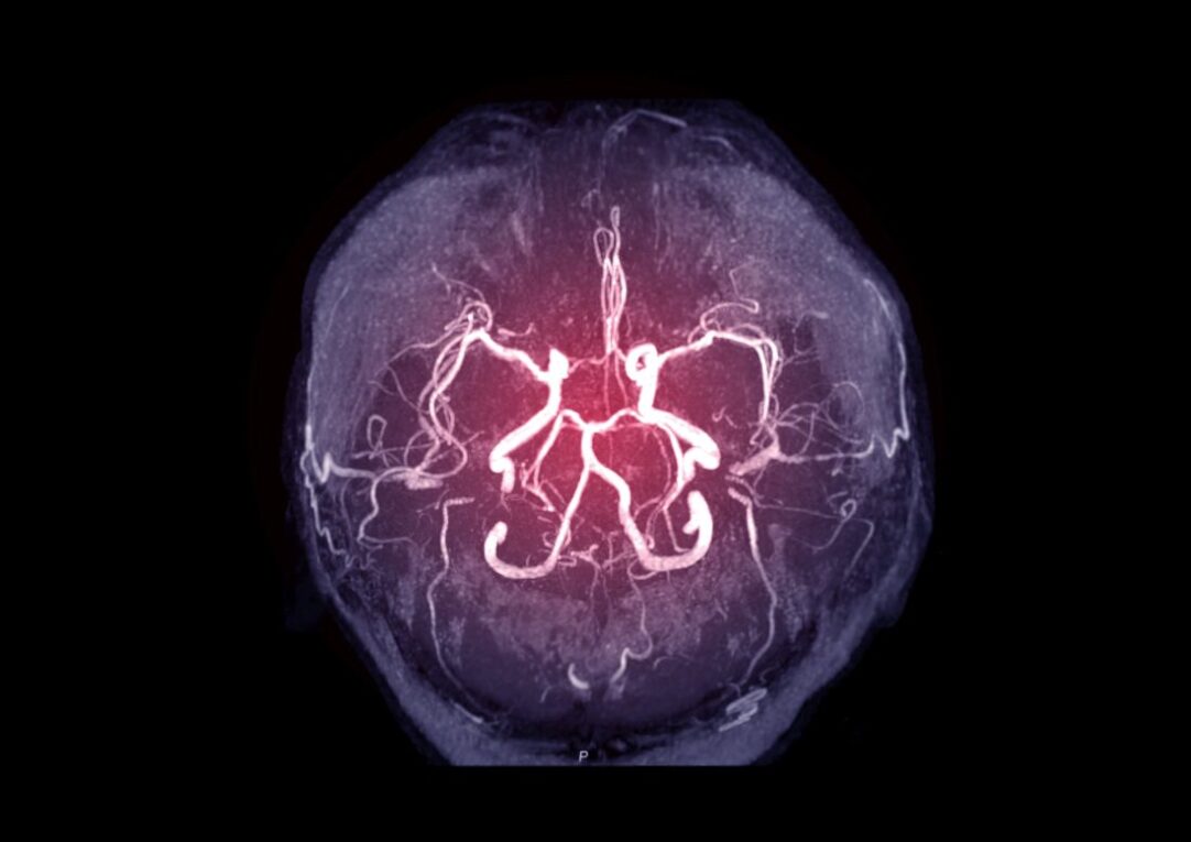Cerebral Angiography: A Vital Diagnostic Tool for Brain Disorders