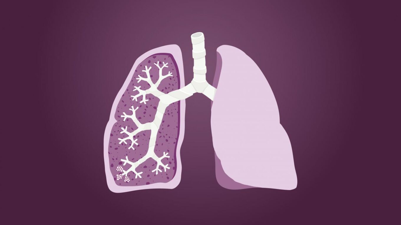 Lung Fibrosis