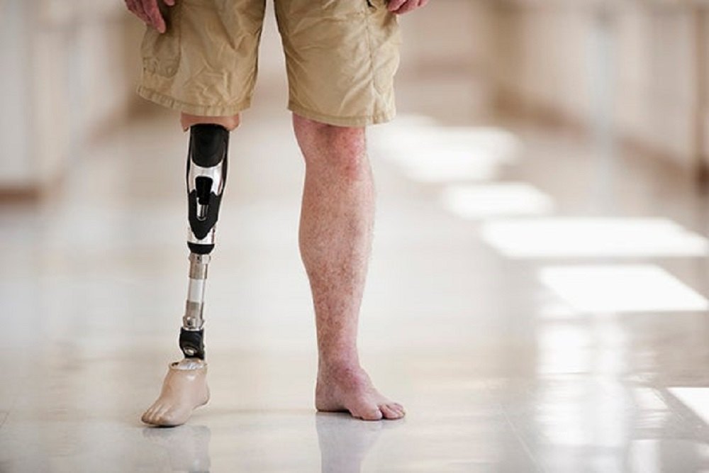 Orthopedic Prosthetics: Enabling Mobility Through Technology