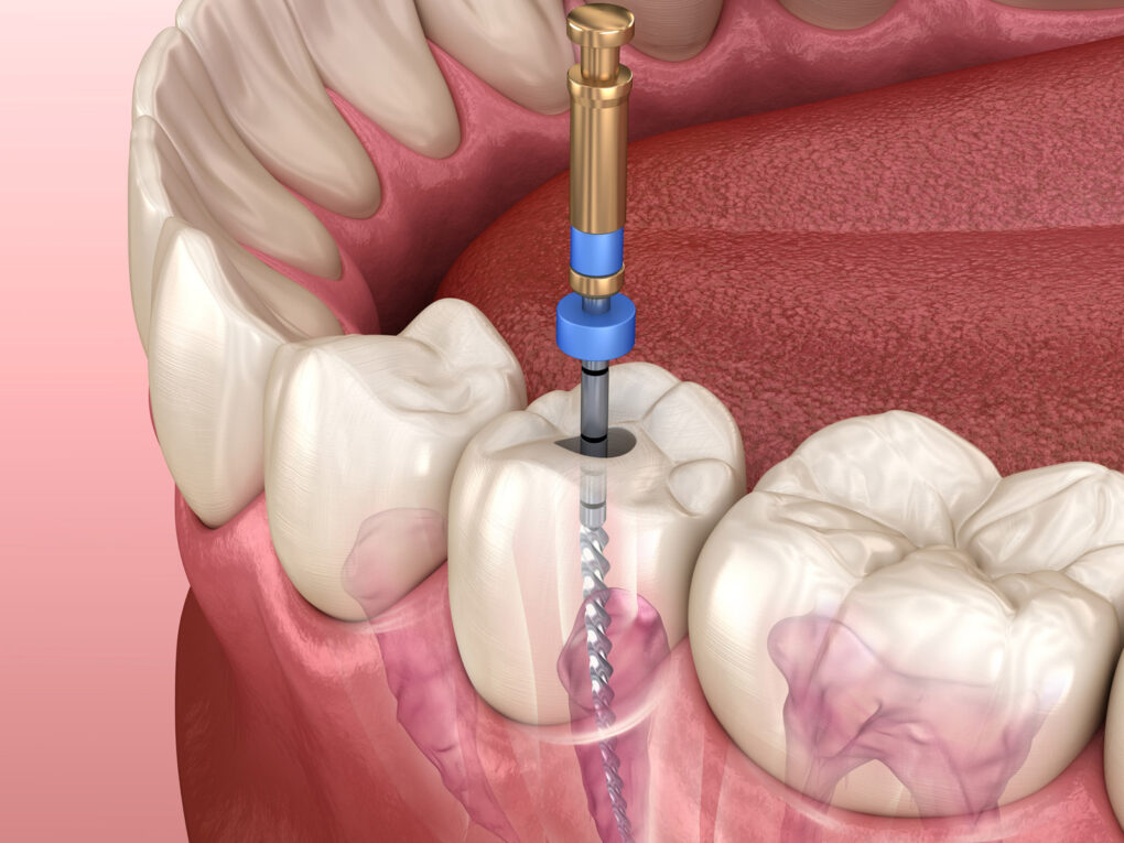 Global Root Canal Files Market is Estimated to Witness High Growth Owing to Increasing Demand for Endodontic Procedures