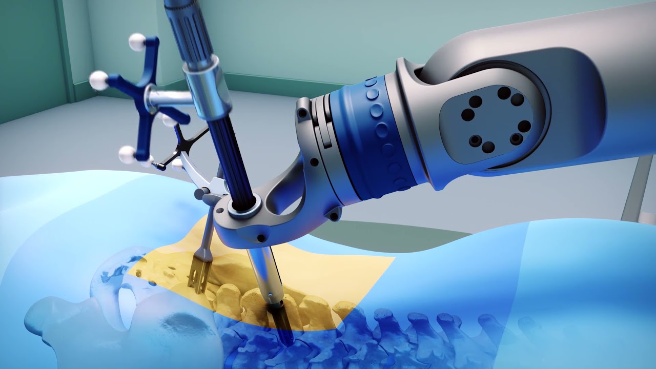 Spine Surgery Robots Market trends with rising adoption of robot-assisted surgeries