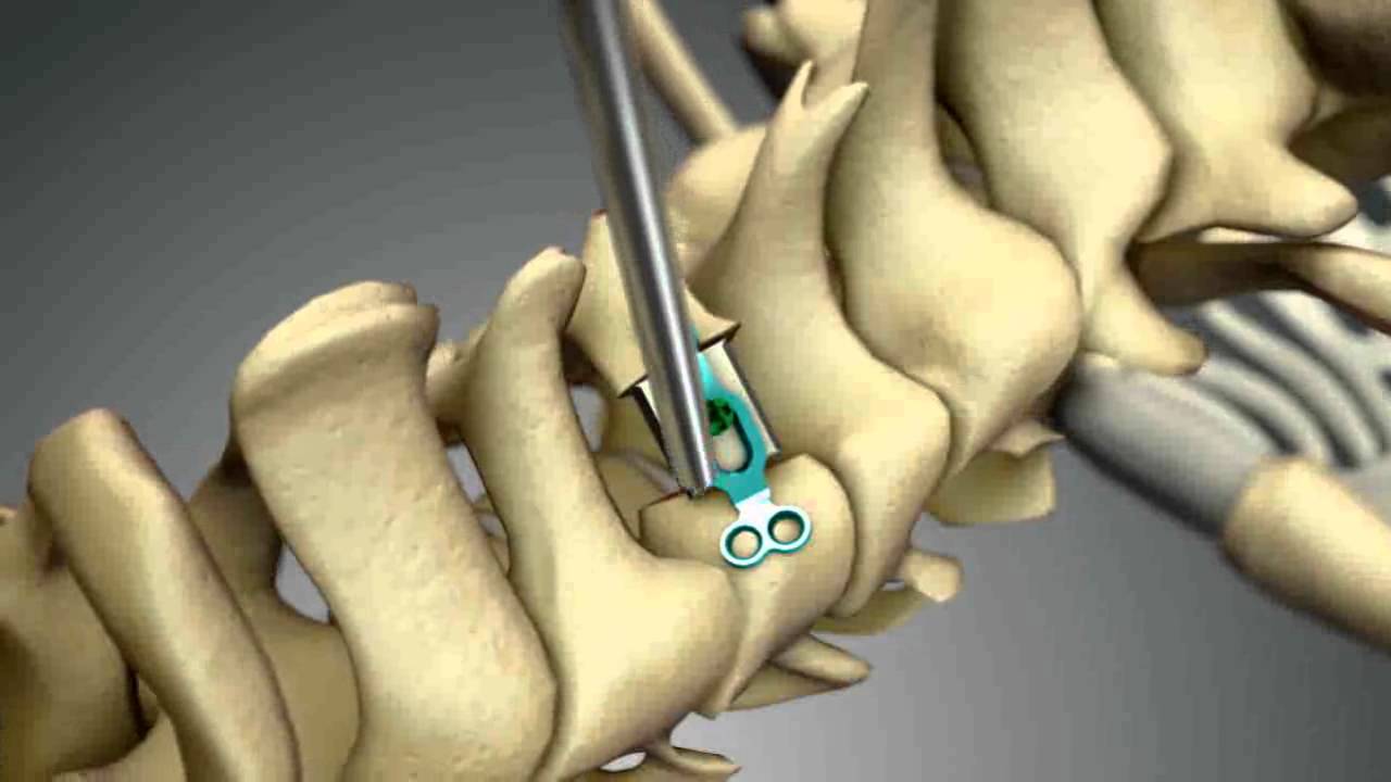 Global Spinal Laminoplasty: Overview