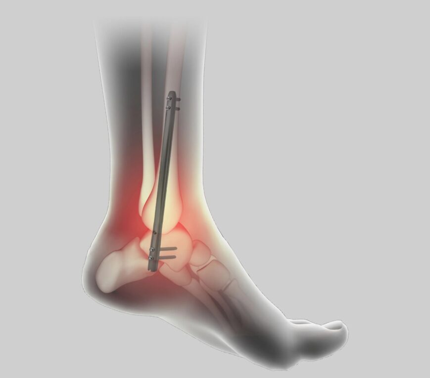 Global Ankle Fusion Nail: A Breakthrough for Ankle Arthritis Treatment