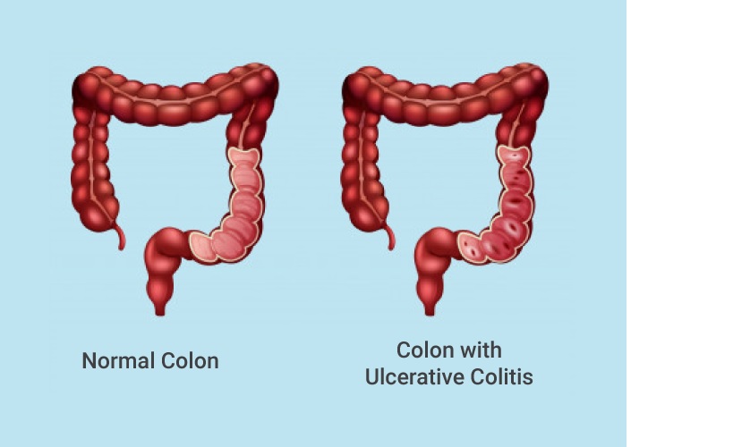 United Kingdom Ulcerative Colitis Industry: New Insights on Ulcerative Colitis Prevalence and Diagnosis in the United Kingdom